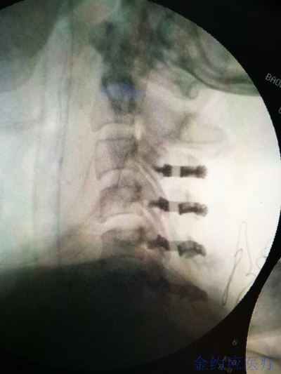 病例分享——頸椎后路椎板成型系統(tǒng)治療C3-C6椎管狹窄