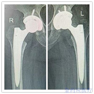 病例分享——微創(chuàng)柄治療雙側(cè)股骨頭壞死